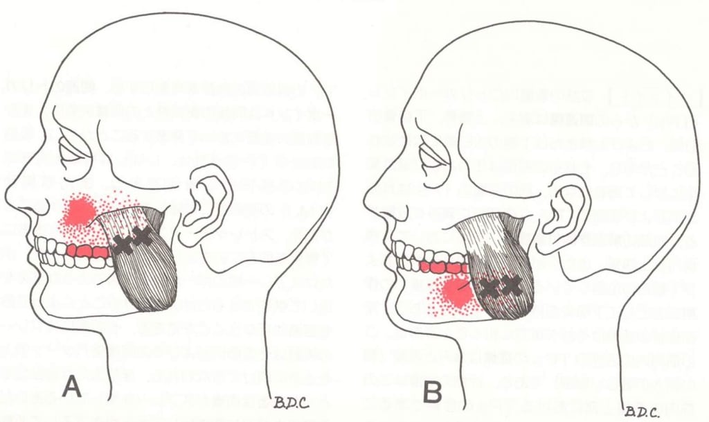 顎関節症のスキャンイメージ